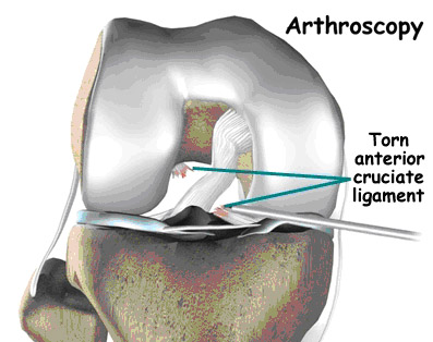 acl tear,acl torn,acl injury,acl reconstruction india,acl reconstruction best india,acl reconstructionbest doctors in india,acl reconstruction best surgeon in india,acl reconstructionbest surgery in india,acl reconstruction best treatment in  india,acl reconstruction in south  india,acl reconstruction north  india,acl reconstruction  east india,acl reconstruction west india,acl reconstruction best in  india,acl reconstruction best surgery in india,acl reconstruction cost-effective in  india,acl reconstruction best doctors in india,acl reconstruction india,acl reconstruction india,acl reconstruction india,acl reconstruction now in india,acl reconstruction india,acl reconstruction by dr.bajaj,acl reconstruction by p.s.bajaj